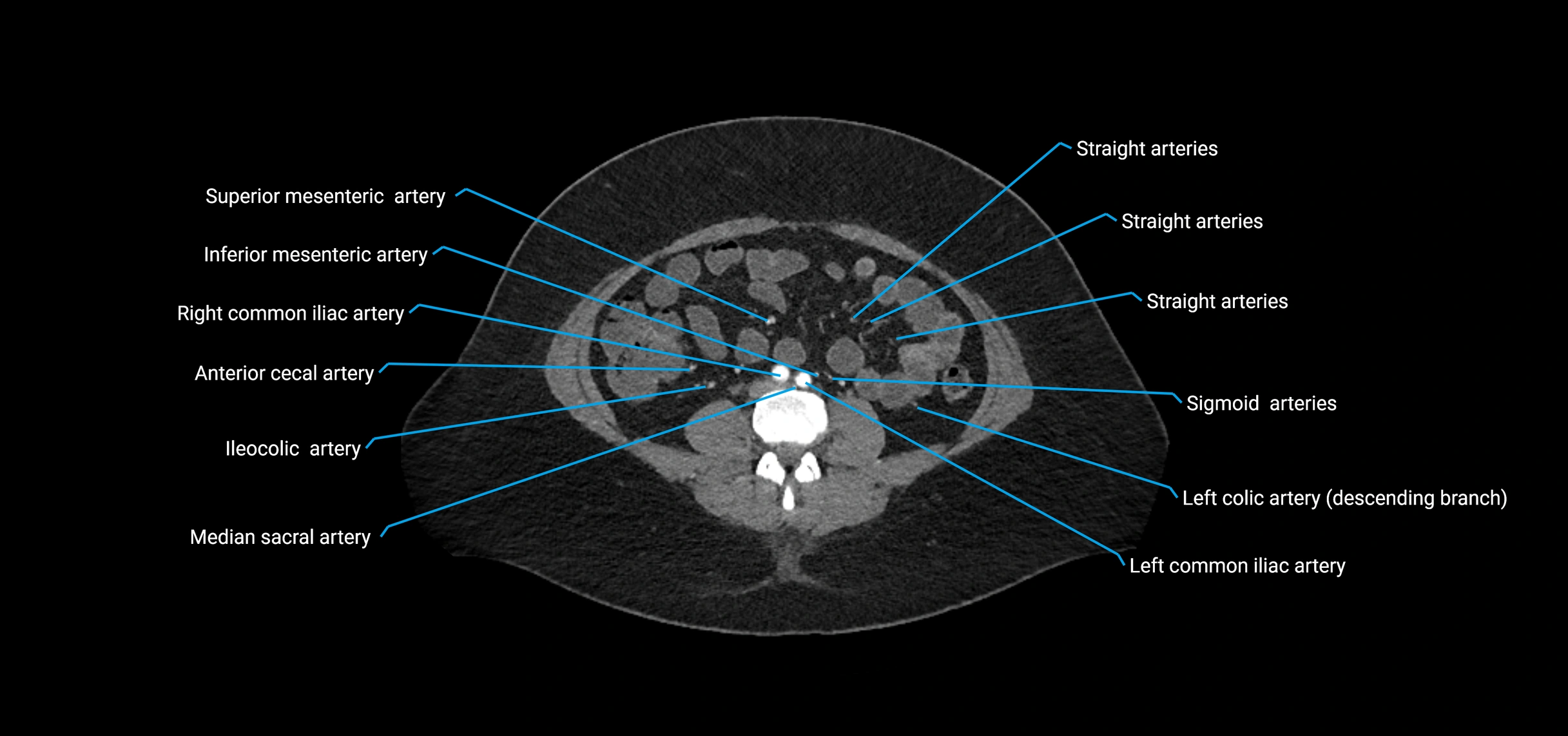 CTA abdomen axial cross sectional anatomy labelled image_132 (2).webp